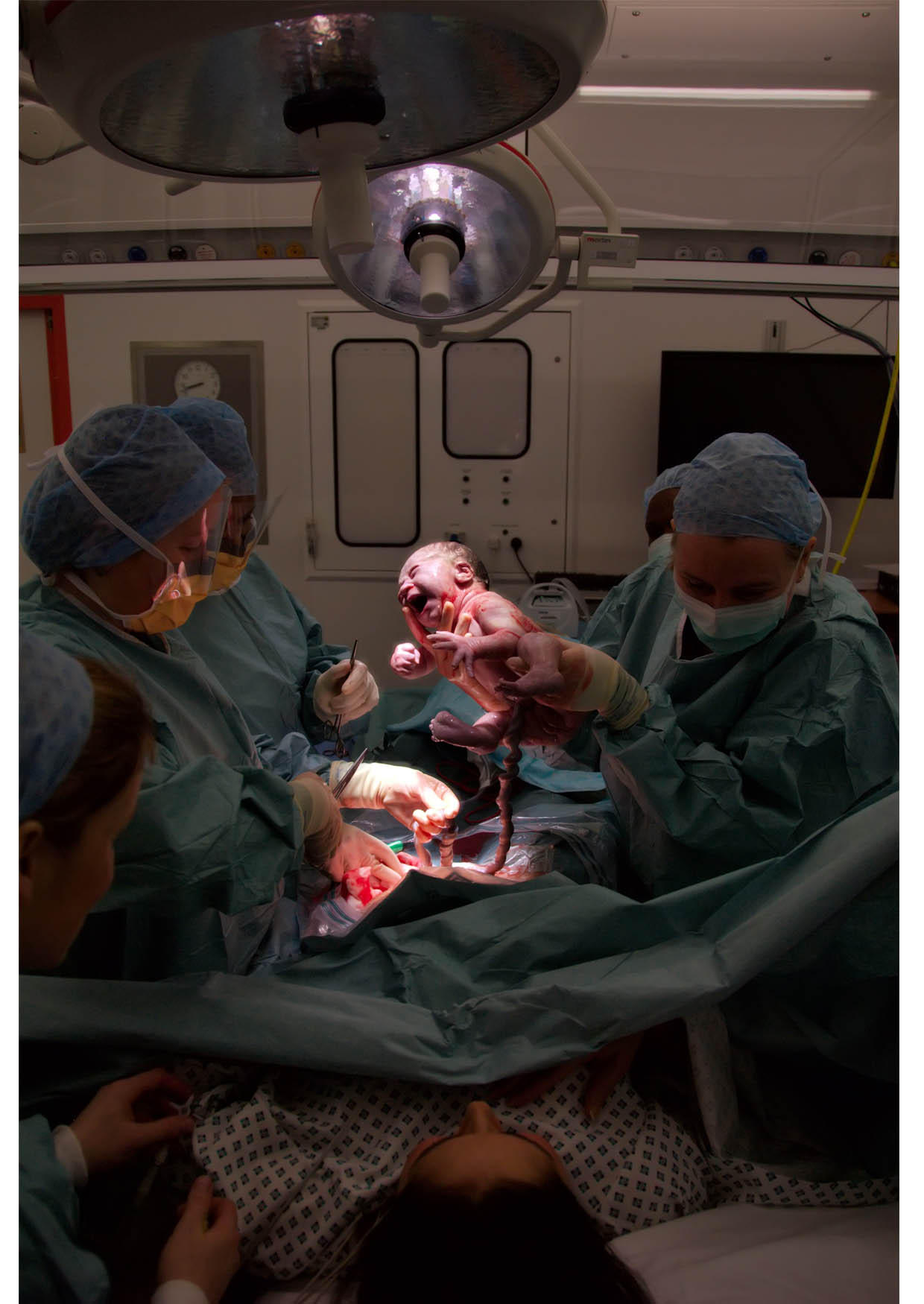 Foto nascita - parto cesario