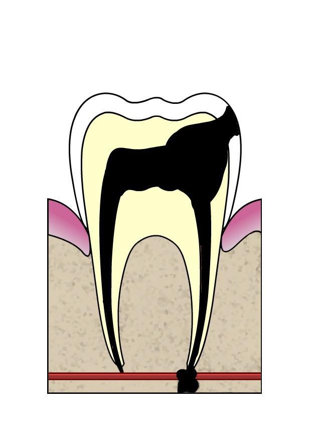evoluzione di una carie immagine evoluzione di una carie