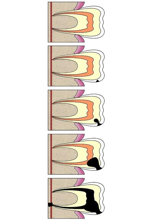 evoluzione di una carie